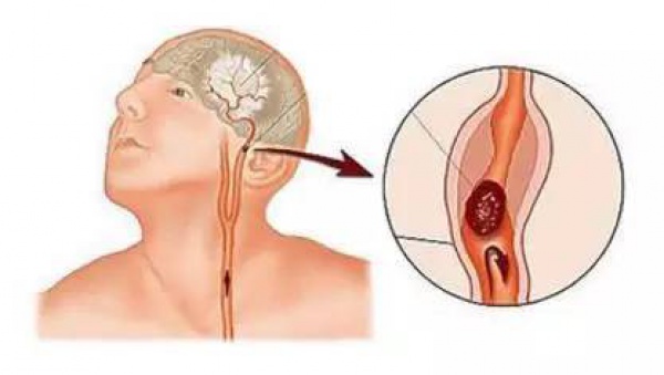 99%的血栓無征兆！記住一個字，讓你遠離這個游走血管的幽靈