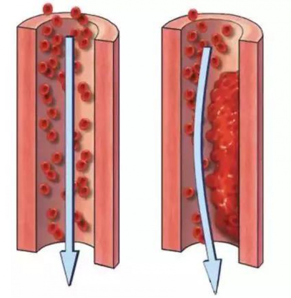 99%的血栓無征兆！記住一個字，讓你遠離這個游走血管的幽靈
