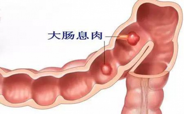 體檢中發現胃腸息肉怎么辦，切還是不切？九成腸癌由息肉轉變而來