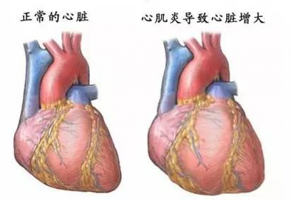 29歲年輕媽媽發病一周后死亡，這種病常盯上身體好壓力大的青壯年